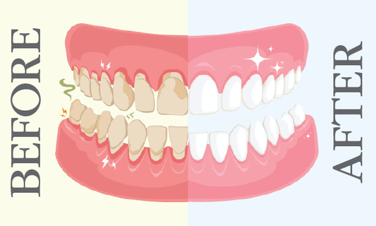 Accidental Discovery that Led To the First Gum Restore Toothpaste