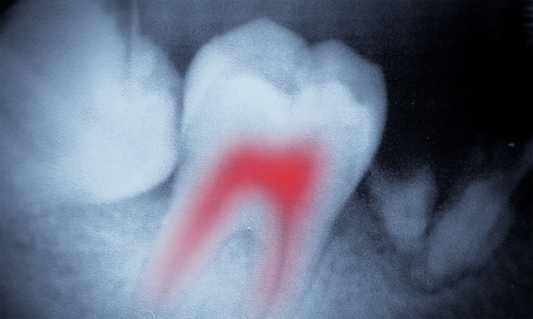 Keeping Root Canal-Treated Teeth Healthy: The Importance of Gum Care